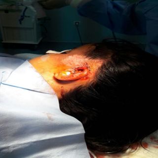 فريق طبي مستشفى #بللحمر ينجح في إعادة أذن طفلة تعرضت لحادث دهس