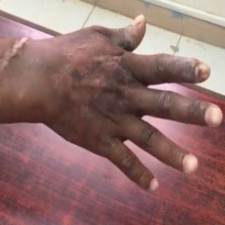 انقاذ يد مُقيم من البتر مستشفى #صامطة العام