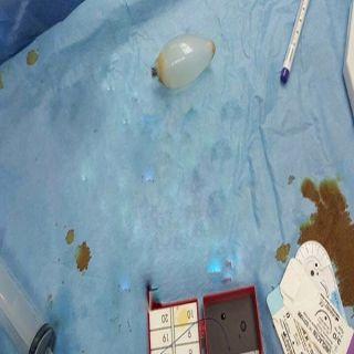 فريق طبي بمستشفى الأمير سعود بن جلوي بـ الأحساء يُخرج "لمبة" من بطن آسيوي