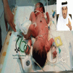 "عسير" وزير الصحة يوجه بنقل سياميين ابها إلى الرياض