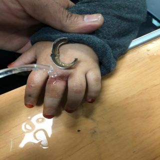 مدني #بريده يحرر اصبع طفله من قطعه معدنيه