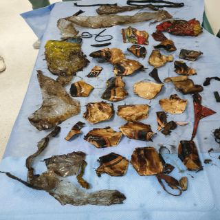 إستخراج 30 قطعة بلاستيكية من بطن شاب 16 عاماً بمستشفى الملك فهد بـ #جدة