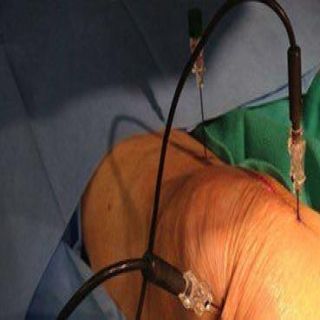 فريق طبي ينجح في إجراء عملية بدون جراحة لخشونة الركبة بمستشفى الملك فهد بجدة