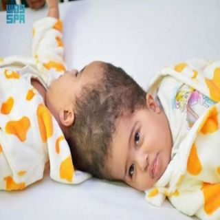 الفريق الجراحي يٌعلن نجاح فصل التوأم الملتصق الإريتري «أسماء وسمية»