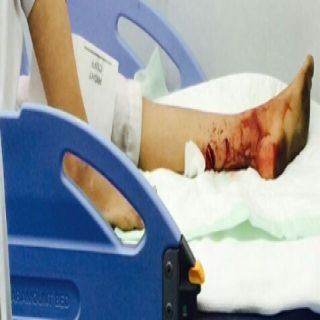 إصابة طفل بجروح اثر مهاجمة قرود له بغابة رغدان بالباحة